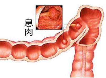 肠息肉的症状表现图片